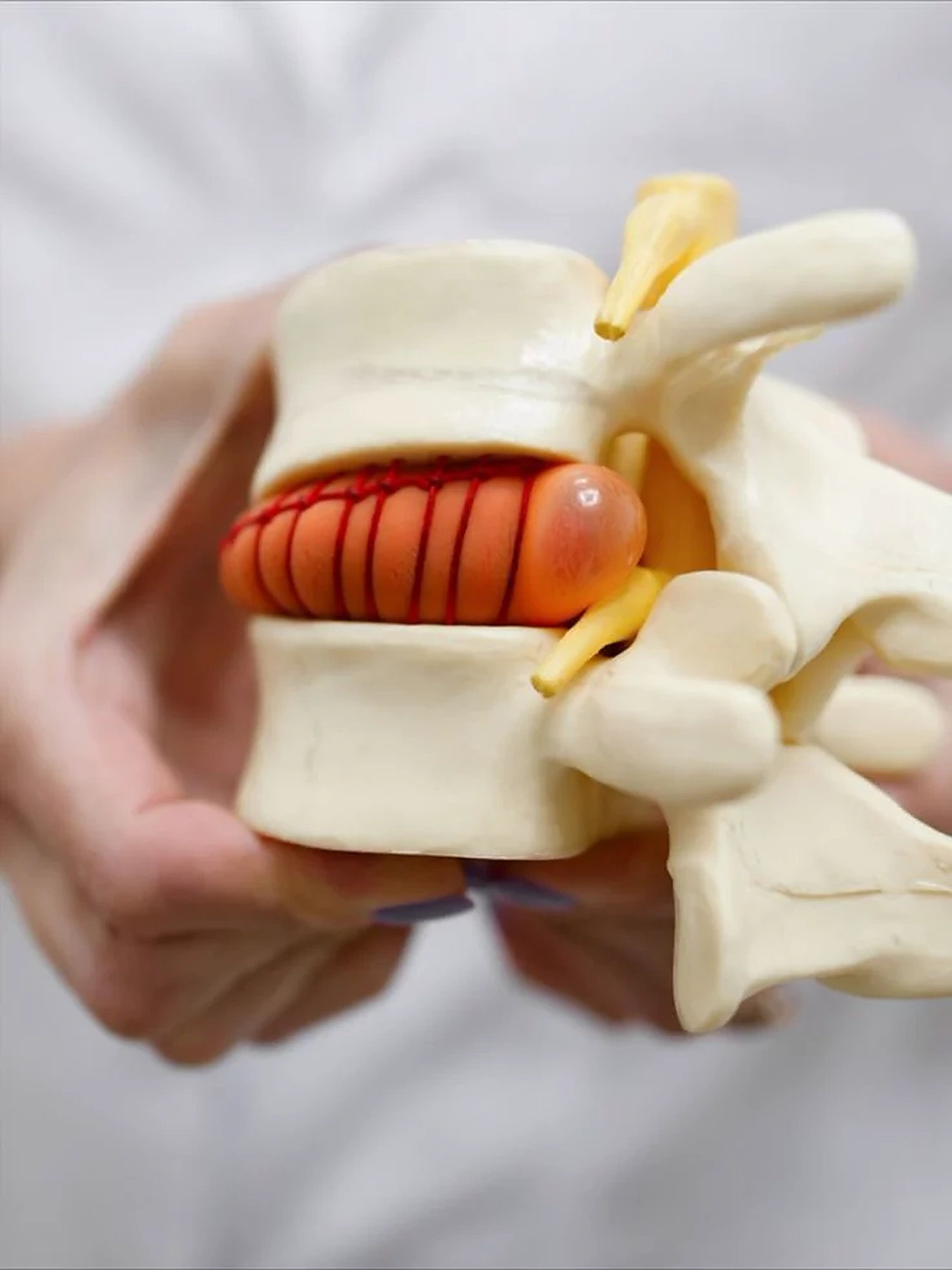 Modelo de columna lumbar con disco intervertebral para explicar el dolor lumbar y la ciática